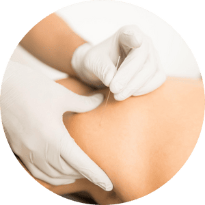 acupuncture